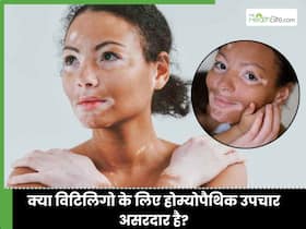 होम्योपैथी की कौन सी दवा से सफेद दाग सही होते है? जानिए पुराने विटिलिगो का इलाज क्या है?