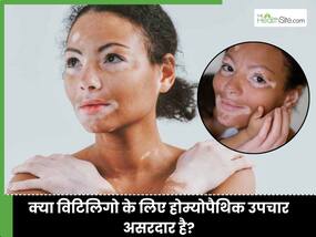 होम्योपैथी की कौन सी दवा से सफेद दाग सही होते है? जानिए पुराने विटिलिगो का इलाज क्या है?