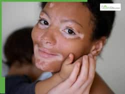 'Vitiligo Is Contagious', And Other Myths About This Chronic Skin Condition Busted