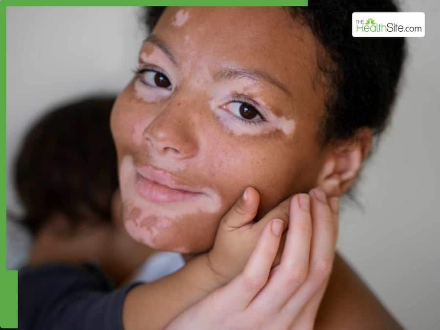 'Vitiligo is contagious', and other myths about this chronic skin condition