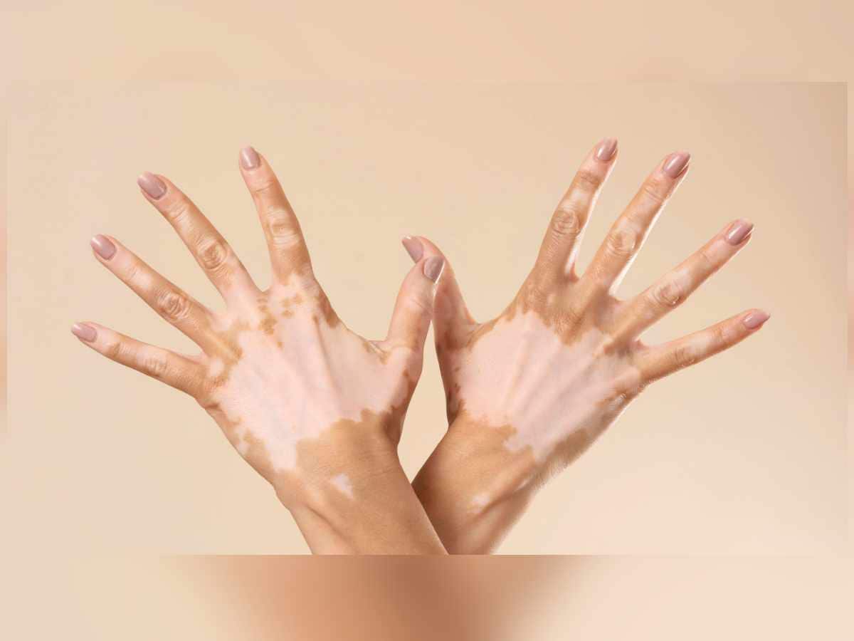 Vitiligo, vitiligo causes, vitiligo myths, vitiligo treatment, vitiligo facts, vitiligo symptoms, vitiligo methics vs. facts, vitiligo skin conditions, vitiligo contagious, vitiligo infectious, vitiligo affects eyes and hair, vitiligo skin patches affect the eyes and hair 