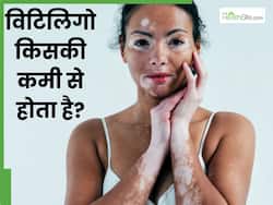 विटिलिगो किसकी कमी से होता है? डॉक्टर से जानें सफेद धब्बों को कम करने के टिप्स