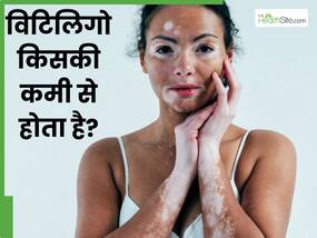 विटिलिगो किसकी कमी से होता है? डॉक्टर से जानें सफेद धब्बों को कम करने के टिप्स
