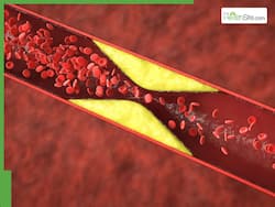 High Cholesterol Management: 5 Superfoods To Reduce LDL Or Bad Cholesterol Naturally