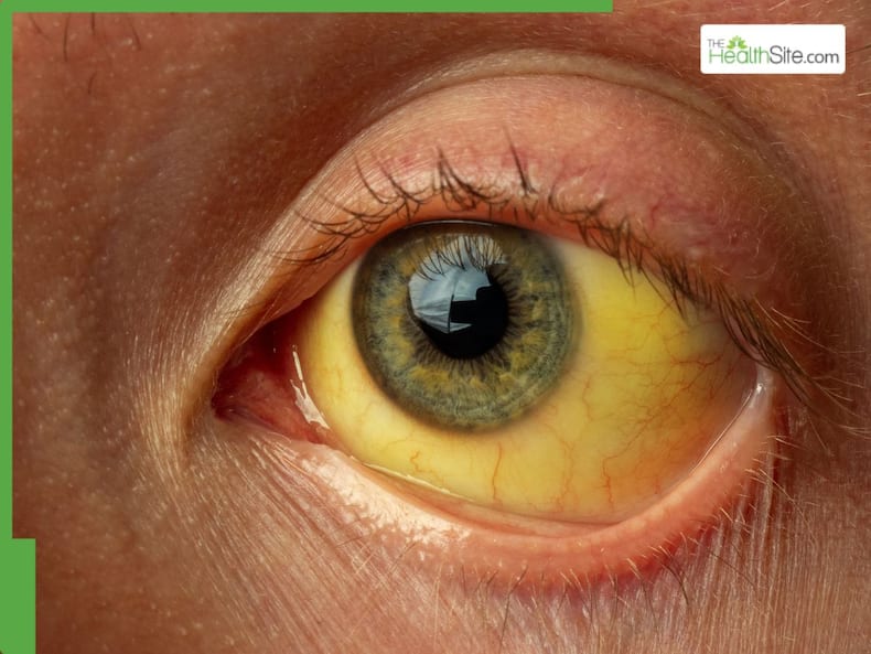 Symptoms Of Liver Failure That Can Show Up At Night