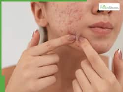 Fight Monsoon Skin Issues: Home Remedies For Acne And Pimples