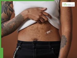 7 Simple Ways To Get Rid Of Body Acne