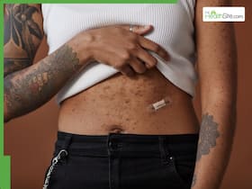 7 Simple Ways To Get Rid Of Body Acne