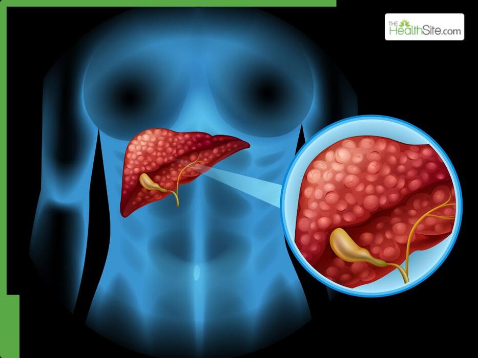 Fatty Liver Diet: 5 Monsoon Superfoods To Flush Out Excess Fat From The Liver