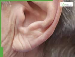 Ear Lobe Crease (Frank   s Sign): Can It Predict Heart Attack or Stroke? Know What Study Says
