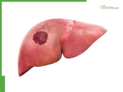 5 Ways Fatty Liver Can Show Up On Your Face