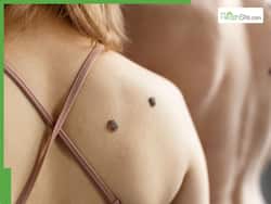 World Skin Health Day 2025: Here's How You Can Naturally Get Rid Of Skin Tags At Home