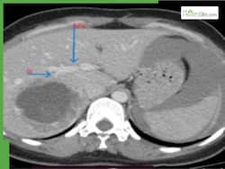12-Week Foetus Found Growing Inside Woman   s Liver: Rare Hepatic Ectopic Pregnancy Case Stuns UP Doctors