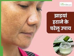 पुरानी से पुरानी झाइयों को जड़ से खत्म कर देंगे ये 5 घरेलू उपाय, हर कोई पूछेगा निखरी त्वचा का राज