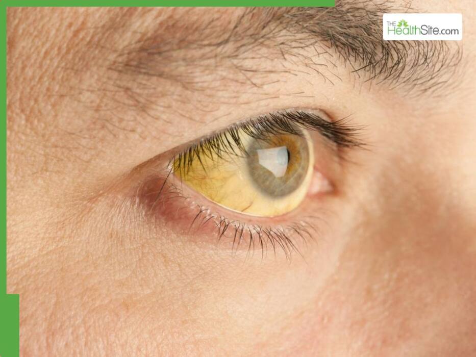 5 Ways Fatty Liver Can Show Up On Your Face