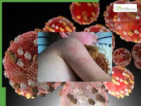 Measles Outbreak In The US: Country Reports Highest Ever Cases In Last Many Decades