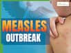 Measles Outbreak LIVE Updates: US Surpassed 1,100 Fresh Cases In Two Months - Expect More Deaths Next, Says Officials