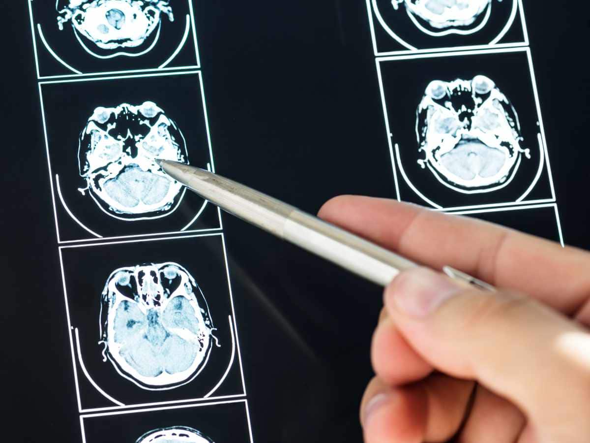 Pediatric brain tumor, Pediatric Brain Tumors Treatment, brain tumour awareness, children healthcare, Childhood brain tumour, brain tumours in children, Pediatric brain tumor treatment, surgery for Pediatric brain tumor, Pediatric brain tumor cure, signs and symptoms of Pediatric brain tumor, Pediatric brain tumor types, Pediatric brain tumor challenges and complications