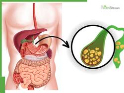 Gallbladder Patients: What Should You Eat And Avoid During Monsoon Season