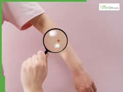 Researchers Found Direct Link Of Beta Human Papillomavirus For Skin Cancer: What Is It?