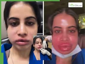 Uorfi Javed Suffers Severe Swelling After Lip Filler Gone Wrong     Fans Shocked Seeing Her Face Swollen, Unrecognisable