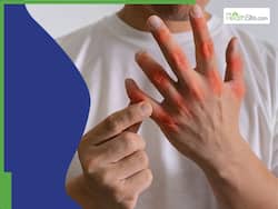 Uric Acid Management: 7 Easy Ways To Tackle High Uric Acid