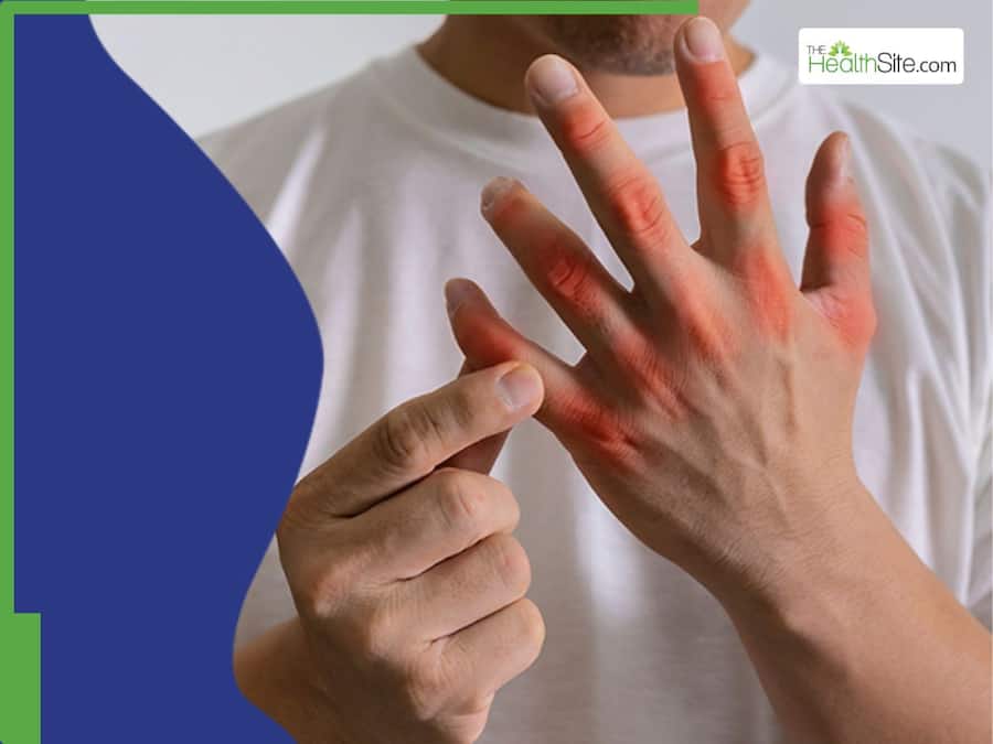 Uric acid management: 7 easy ways to manage gout symptoms