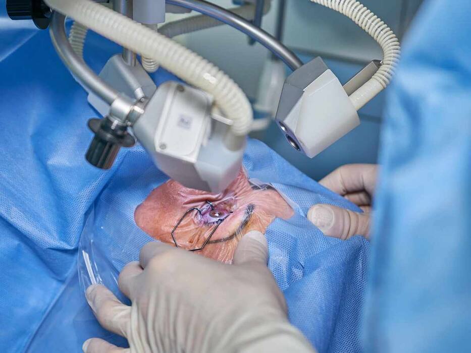 7 Important Things To Know About Cataract Surgery