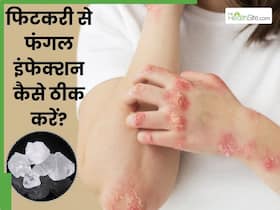 फिटकरी से ठीक करें फंगल इंफेक्शन, इस तरह इस्तेमाल करने से मिट जाएगी खुजली और चकत्ते