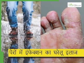 मॉनसून में बार-बार होता है पैरों में फंगल इंफेक्शन तो आजमाएं ये 3 घरेलू उपाय,  मिलेगा दर्द और खुजली से आराम