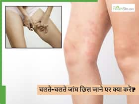 क्या आपकी जांघों की स्किन भी बार-बार छिल जाती है? इन 5 तरीकों से करें इससे बचाव