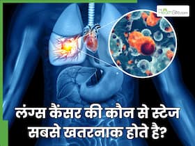 लंग्स कैंसर की कौन से स्टेज सबसे खतरनाक होते है? कैसे पता चलेगा कि कैंसर किस स्टेज में है?