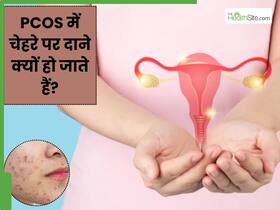 PCOS में चेहरे पर दाने क्यों हो जाते हैं? जानें इसके कारण और बचाव के उपाय