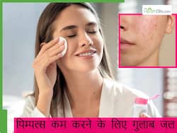 गुलाब जल से पिम्पल्स कैसे रोकें? चेहरे पर इस तरह लगाएं गुलाब जल, कम होंगे एक्ने और पिम्पल्स