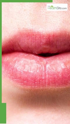 5 Best Ways To Deal With Chapped Lips