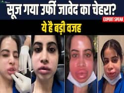 उर्फी जावेद का चेहरा क्यों सूजा? जानें लिप फिलर्स हटाने के बाद क्या होता है?