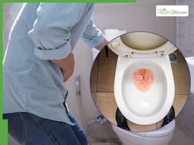 Why Painless Blood in Urine Should Never Be Ignored