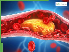 5 Warning Signs of High Cholesterol on the Face You Shouldn't Ignore