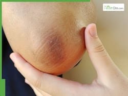5 Effective Home Remedies To Brighten Dark, Pigmented Elbows Naturally