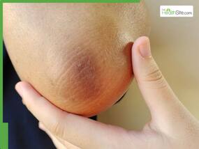 5 Effective Home Remedies To Brighten Dark, Pigmented Elbows Naturally