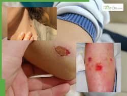 Skin Cancer Symptoms: 5 Warning Signs Of Skin Cancer You Should Never Ignore