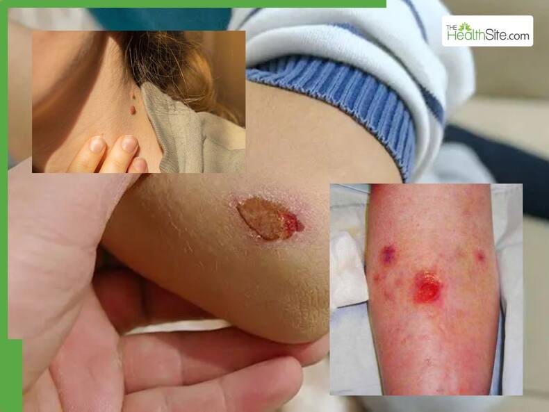 Skin Cancer Symptoms: 5 Warning Signs Of Skin Cancer You Should Never Ignore