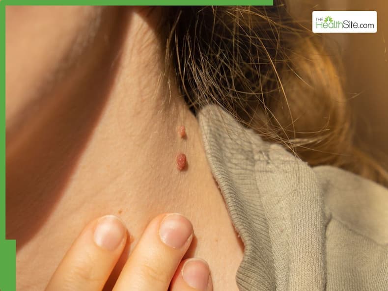Skin Cancer Symptoms: 5 Warning Signs Of Skin Cancer You Should Never Ignore