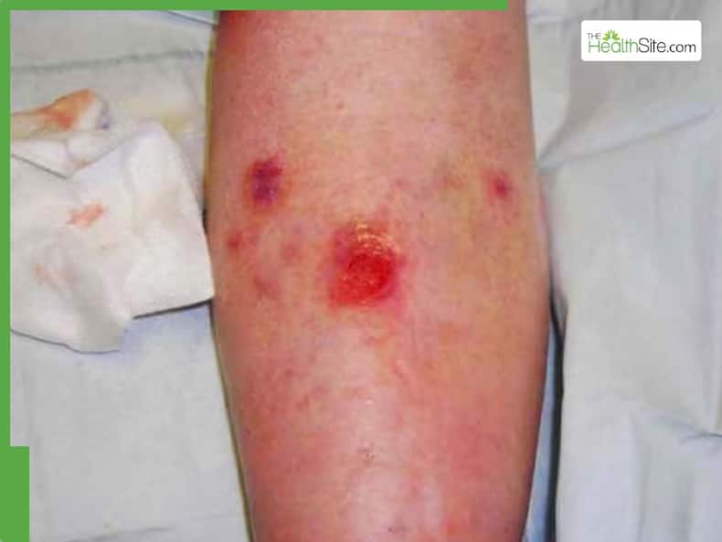 Skin Cancer Symptoms: 5 Warning Signs Of Skin Cancer You Should Never Ignore