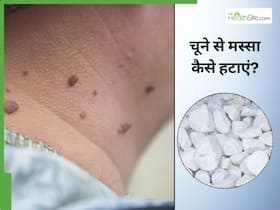 चूने से हटाएं शरीर पर निकले अनचाहे मस्से, बस करना होगा ऐसे इस्तेमाल