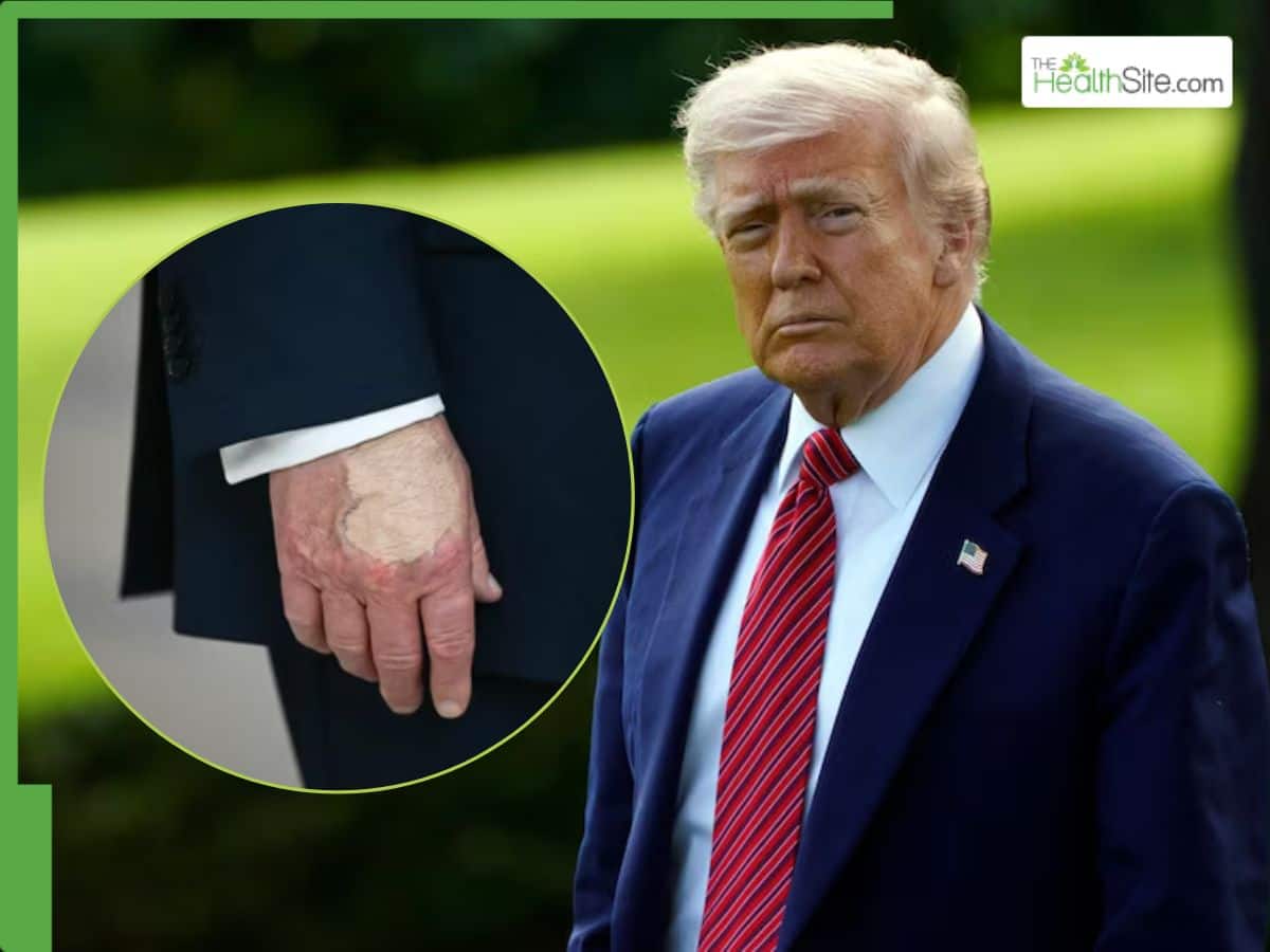 Donald Trump Health Update: US President Appears With Makeup-Smeared Hand, Fueling Rumours Again