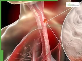 Esophageal Cancer Warning Signs: How to Spot Symptoms Early and Reduce Your Risk Esophageal Cancer Warning Signs: How to Spot Symptoms Early and Reduce Your Risk
