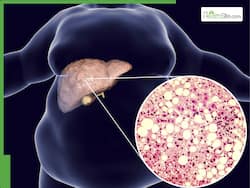 Fatty Liver Crisis Among Hyderabad IT Workers: JP Nadda Flags 84% Affected | Deets Inside