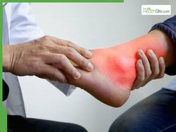 5 Health Conditions High Uric Acid Can Cause