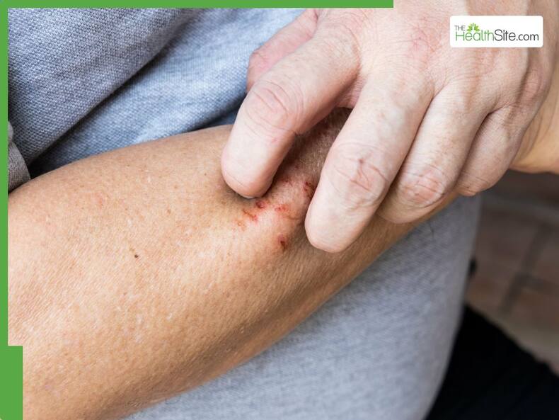 Skin Cancer Symptoms: 5 Warning Signs Of Skin Cancer You Should Never Ignore